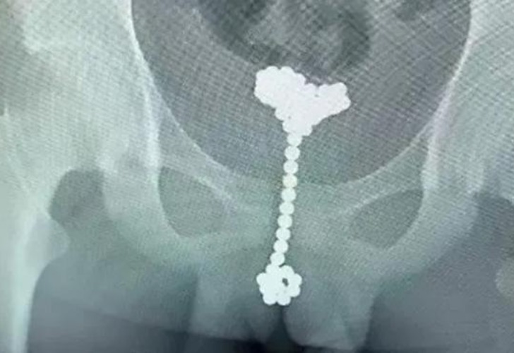 Una cirujana pediátrica advierte en Twitter del peligro de los juegos de bolas  magnéticas para niños