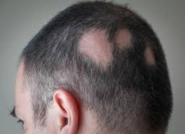 Aseguran que la alopecia podría aumentar durante el aislamiento